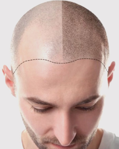 Scalp Micropigmentation Service