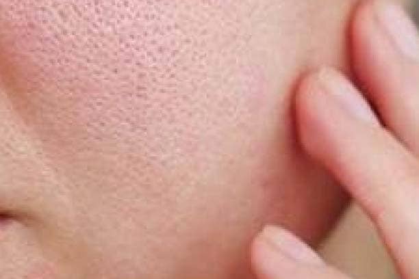 Open Pores Treatment in GK
